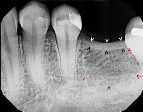 low bone density