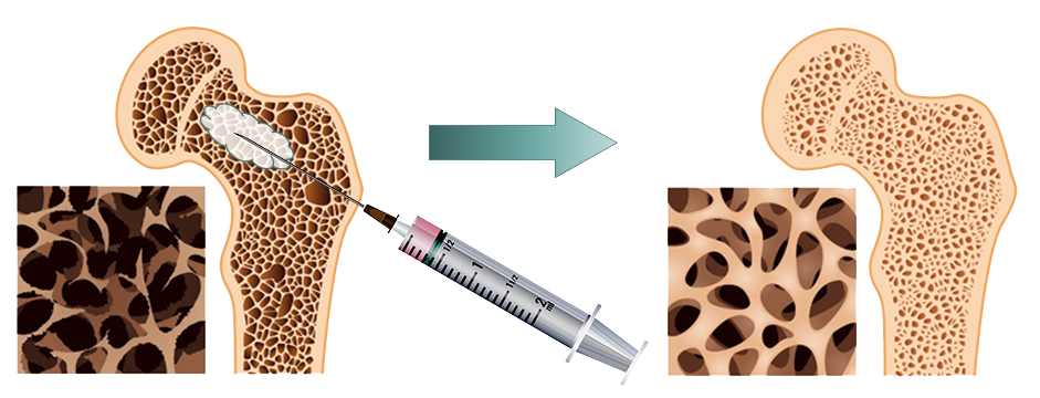 treatment for weak bones